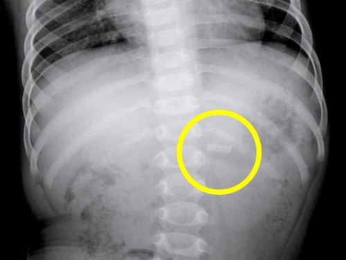 胃内に金属片が確認できた腹部エックス線写真（国民生活センター報道資料より引用）